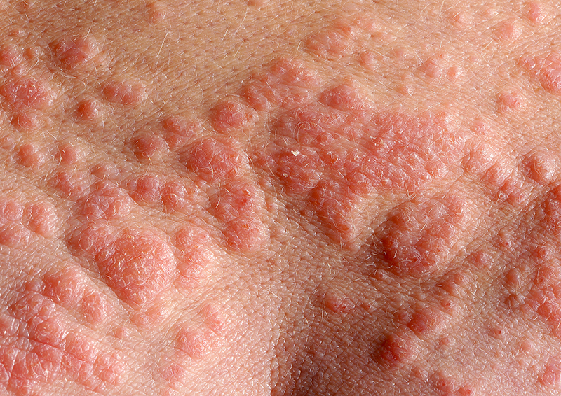 Close-up view of multiple raised red lesions on skin