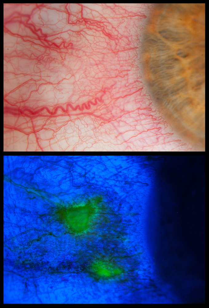 Slit-lamp photographs - fluorescein highlighting conjunctival lesions in green