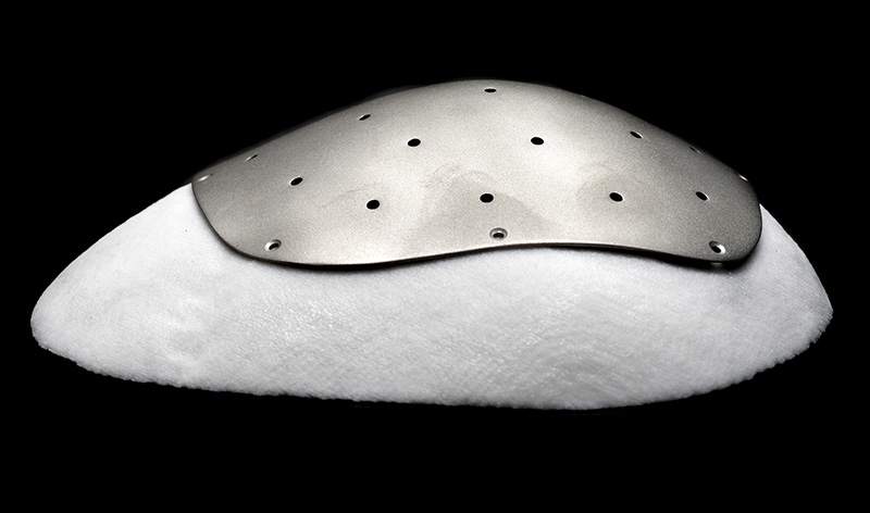 The Ti plate shown in position on a plaster model of the cranial defect