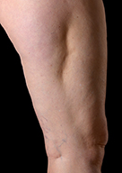 Medial view of left leg showing indentation