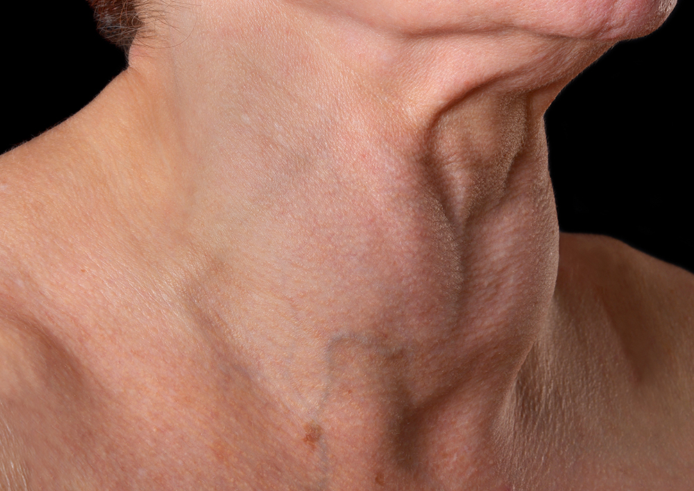 R oblique view of neck