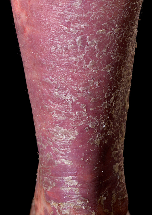 Clinical photo of leg with psoriatic lesions