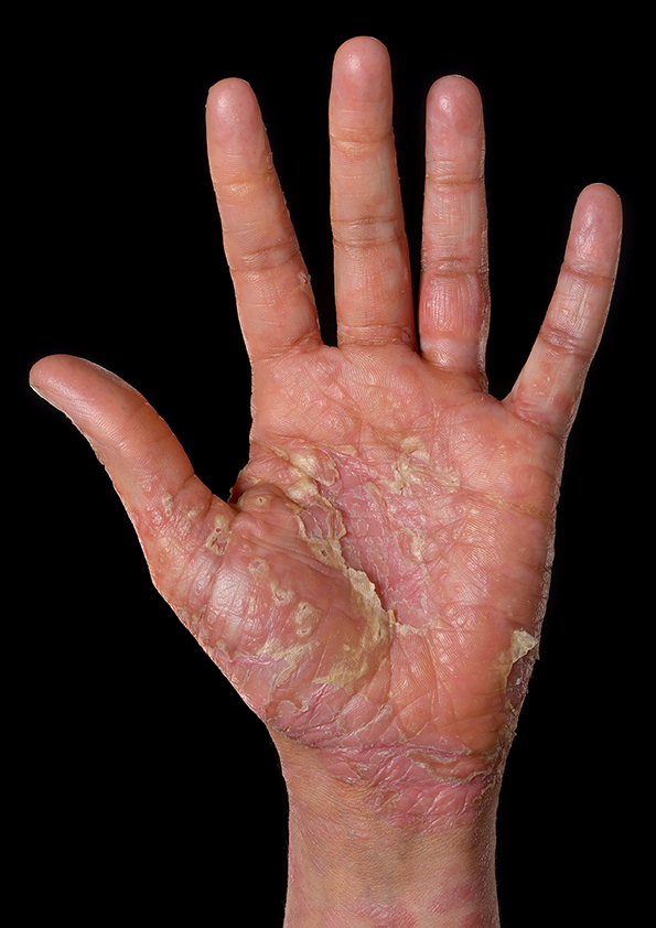 L palm with extensive red and scaly lesions