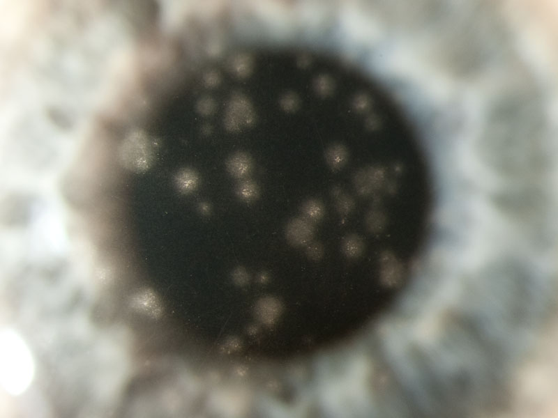 Slit-lamp photo of anterior chamber of eye showing corneal lesions